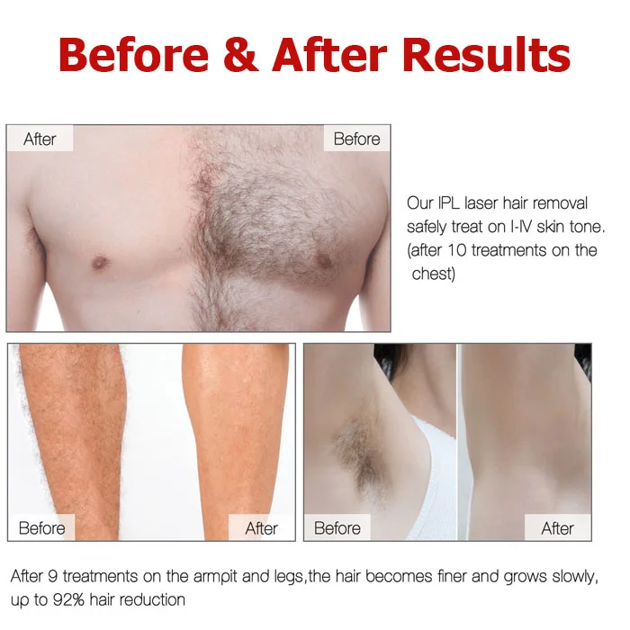 Laser Hair Removal Machine Before & After Results