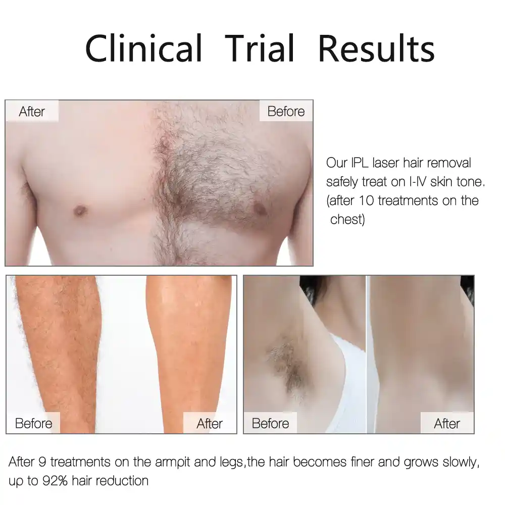 Laser Hair Removal Machine Clinical Trial Results